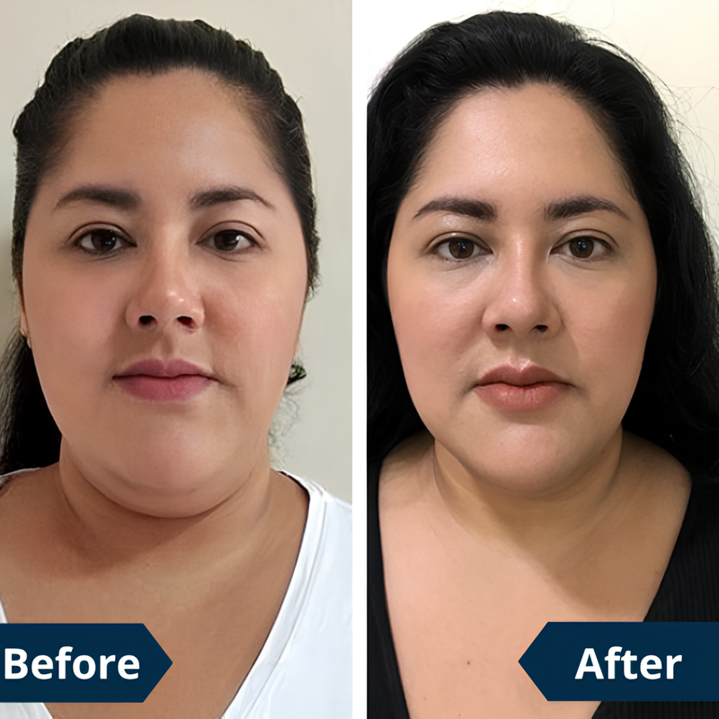 FaceLift™ – Say Goodbye to Double Chin, Hello to Defined Contours