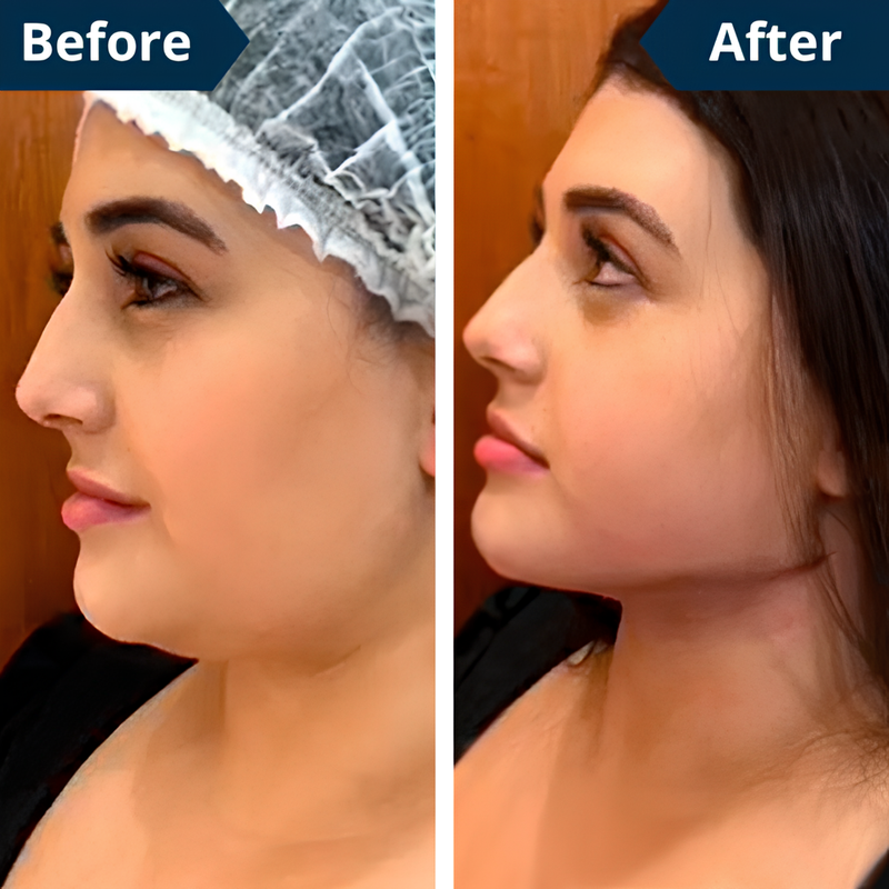 FaceLift™ – Say Goodbye to Double Chin, Hello to Defined Contours