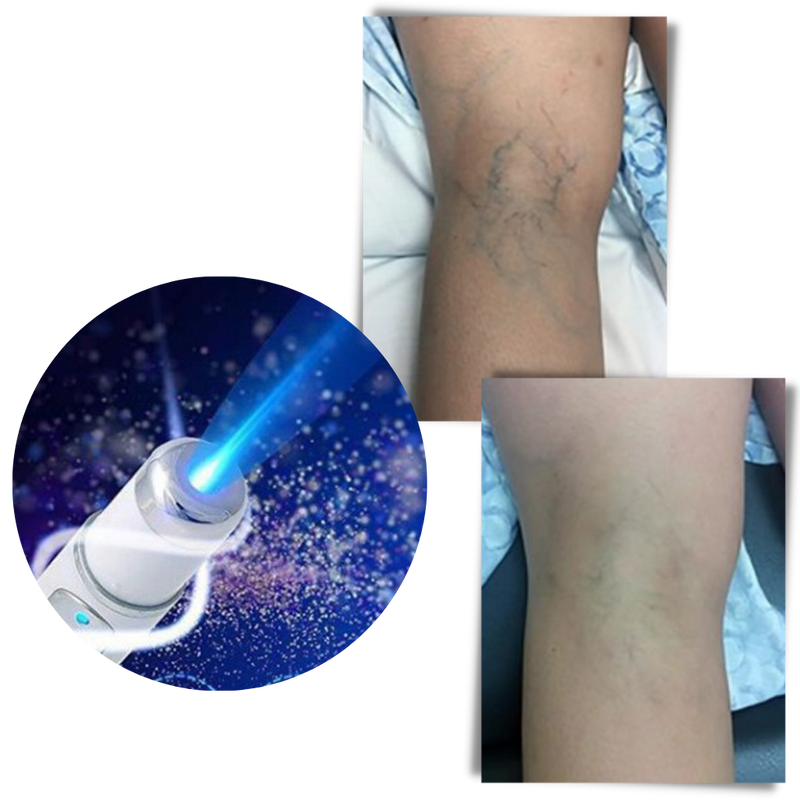 Blue light skin therapy pen