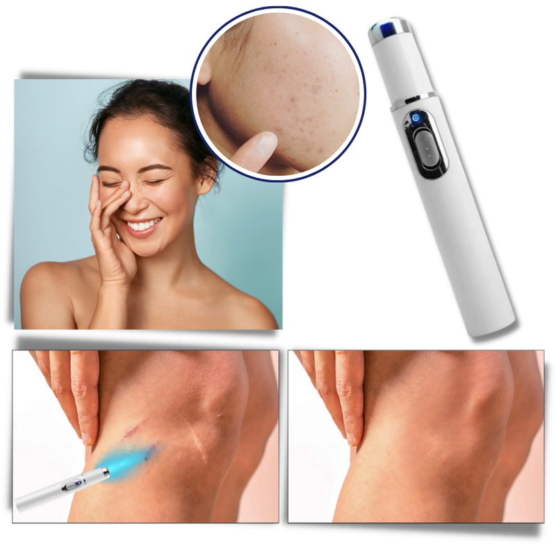 Dark Spot Remover Blue Laser Pen