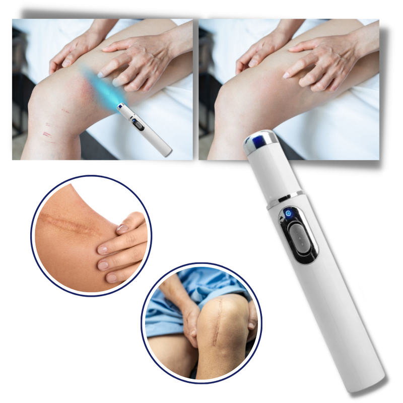 Dark Spot Remover Blue Laser Pen