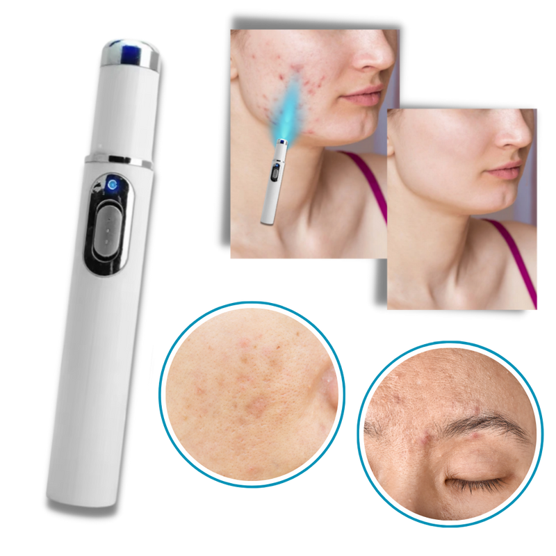 Dark Spot Remover Blue Laser Pen