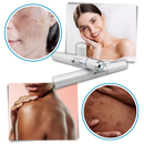 Dark Spot Remover Blue Laser Pen