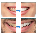 Quick Stain Removal Teeth Whitening