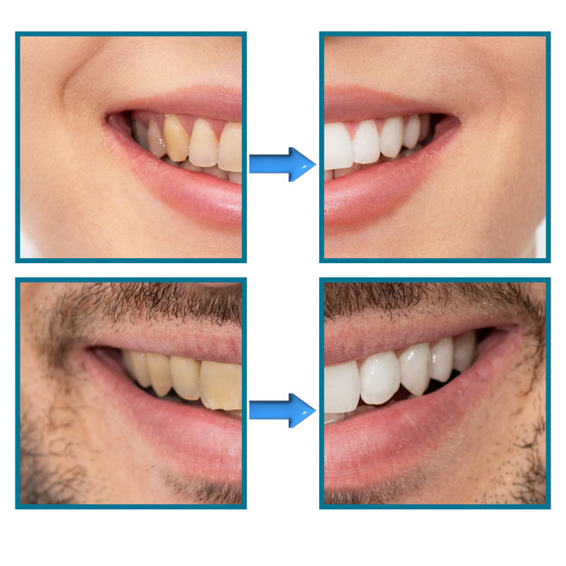 Quick Stain Removal Teeth Whitening
