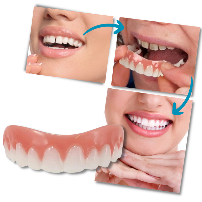 Snap-On Veneer Teeth