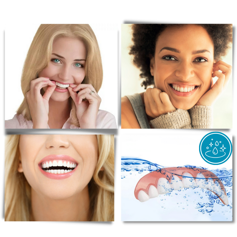 Snap-On Veneer Teeth